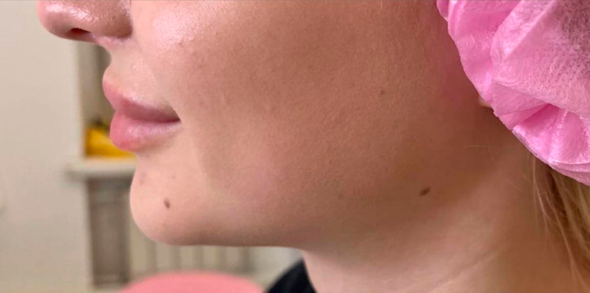 Результат до процедуры