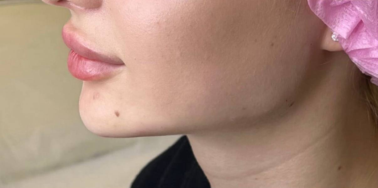 Результат после процедуры